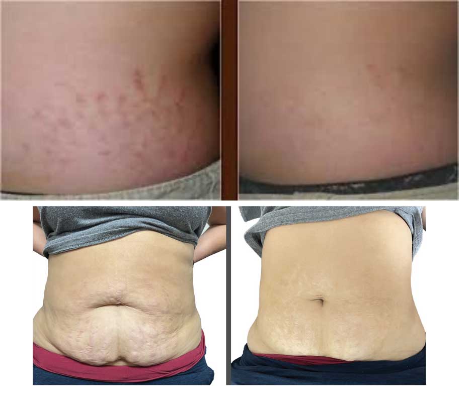 invisa-RED-Stretch-Mark-Reduction-Before-After Before and after comparison of stretch mark reduction on the abdomen using invisa-RED laser technology.
