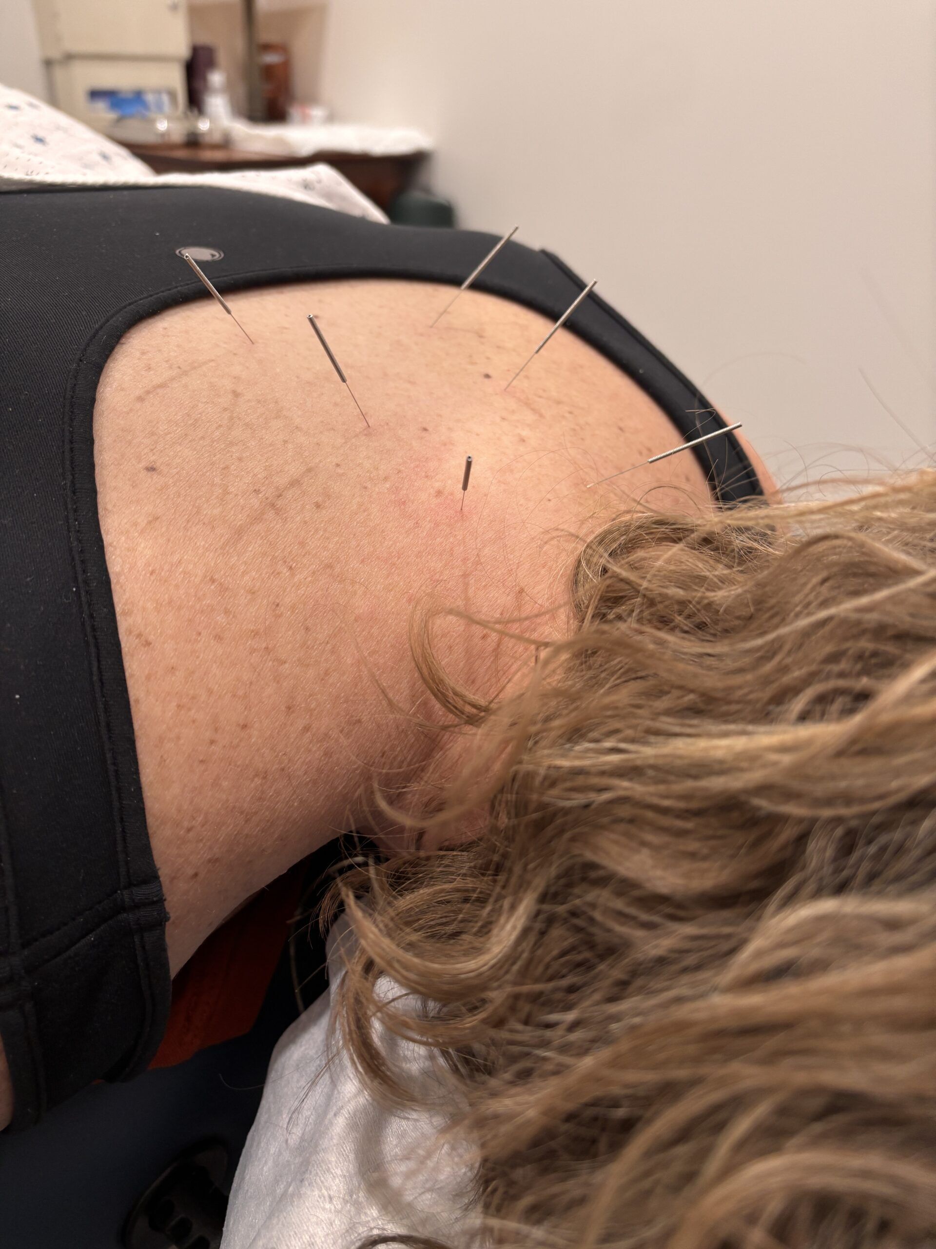 Dry Needling Therapy St. Peter MN | Rising Sun Chiropractic+ Weight Loss Dry needling therapy for trigger point release at Rising Sun Chiropractic + Weight Loss in St. Peter MN