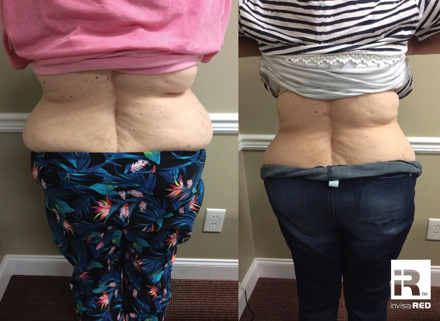 amazing before and after weight loss in st.peter