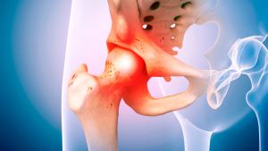 Collagen improves hip pain