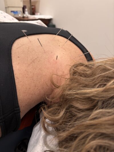 Dry needling treatment at Rising Sun Chiropractic in St. Peter MN