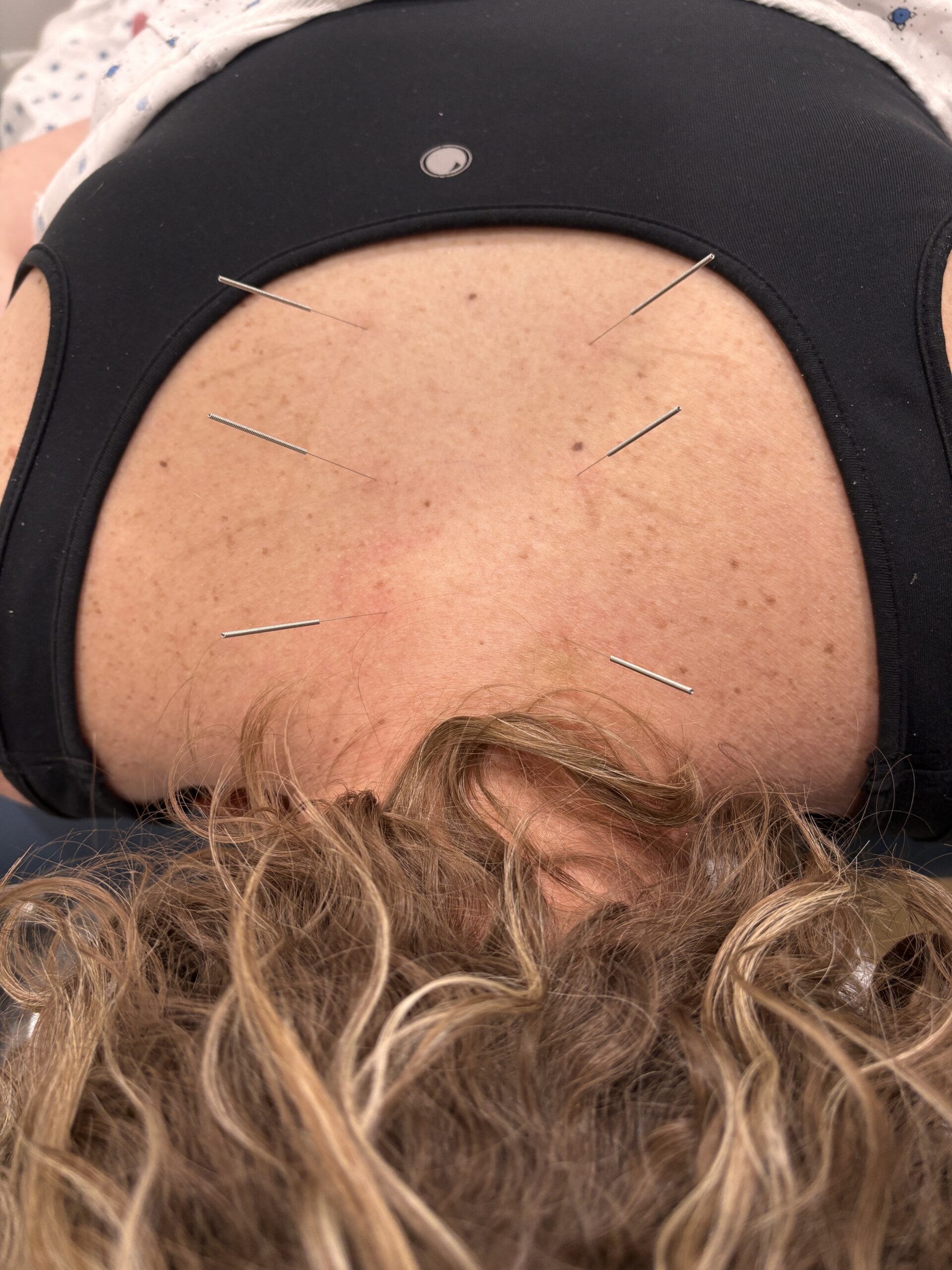 dry-needling-trigger-point clinician performing dry needling St Peter MN