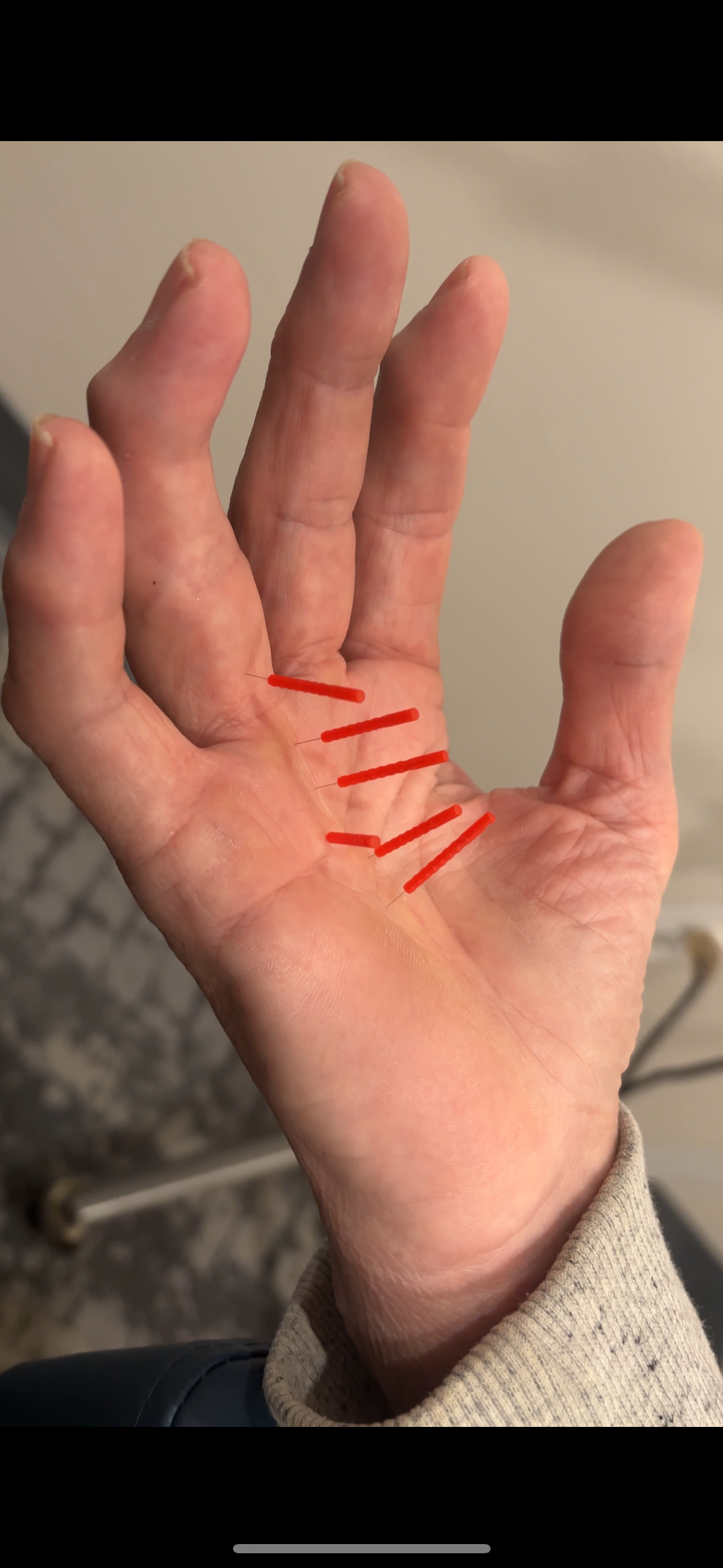 dry-needling-muscle-pain-saint-peter clinician treating muscle spasm saint peter